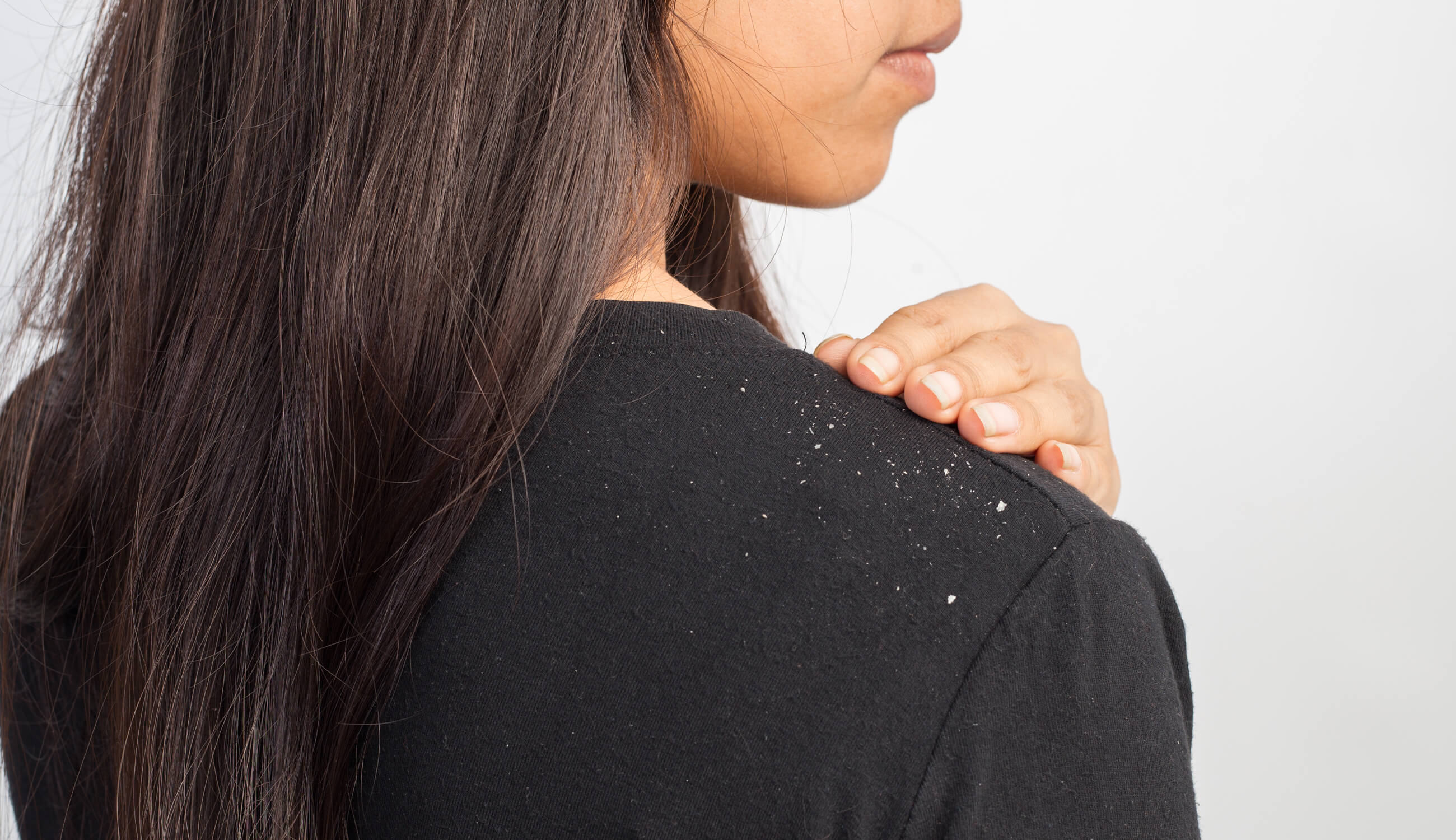 Dandruff on clothing